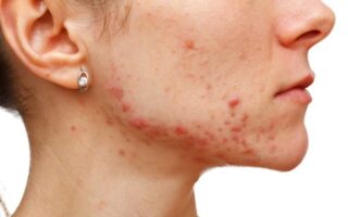 Cómo eliminar el acné